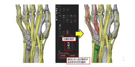 速くて高精度な画像作成を実現！！Ziostation REVORASの新機能　「MR骨抽出」を用いたVR画像の活用