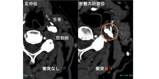 volume scanを用いた頸部Kinematic 4D-CTA