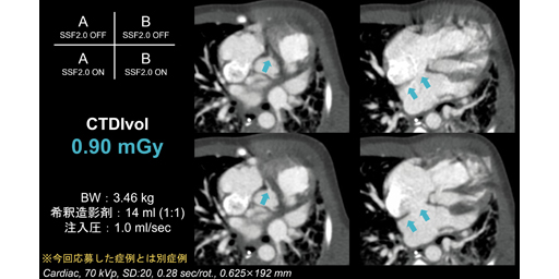 小児心臓CT simulated ECG撮影の有用性