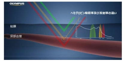 RDI（赤色光観察）：Red Dichromatic Imaging