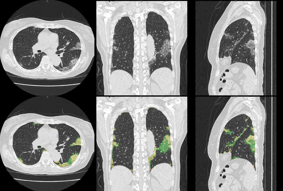 新型コロナウイルス肺炎のCT 診断画像及びその解析結果（上段 原画、下段 解析結果）