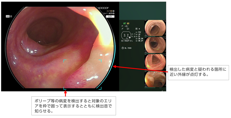 図2：CAD EYE 病変検出支援機能（＊本画像は、一部を加工したイメージ画像）