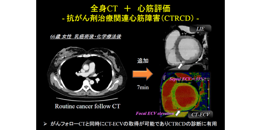 タグ「心筋細胞外容積（ECV）」の検索結果 | 映像情報Medical