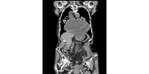 食道裂孔ヘルニアのためのライフスタイルのヒント