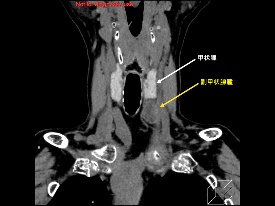 副甲状腺腫におけるダイナミックCT | 映像情報Medical