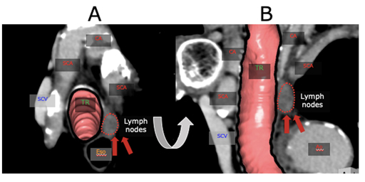 Dual Energy CT を用いた食道がんの補助療法前後における転移リンパ節評価 | 映像情報Medical