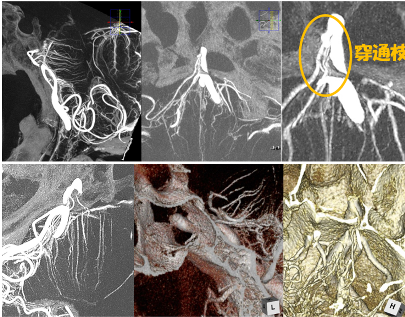高分解能CBCTを用いた穿通枝描出テクニック