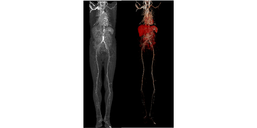 胸部~下肢CTAに対する2断面Test Injection法を用いた造影タイミングの最適化 | 映像情報Medical